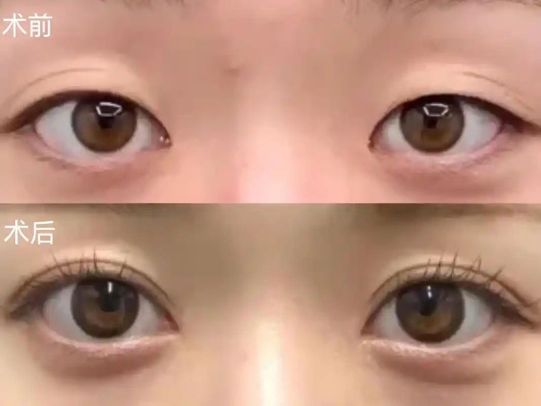 秦海璐做双眼皮的思路都是美商干货!