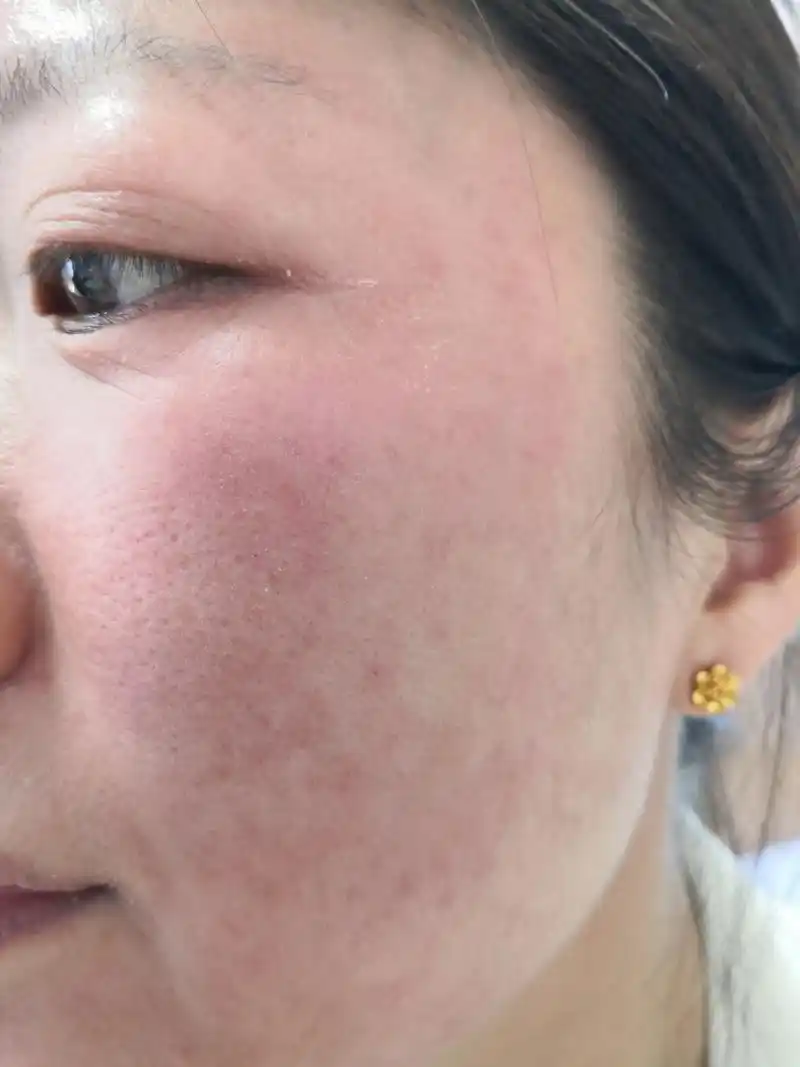 过敏#使用化妆品过敏的这么多是为什么?#解决皮肤问题专注皮肤美容