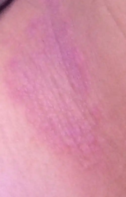 脖子两边都是红的一片,发痒,看看是什么,具体是什么原因引起,具体