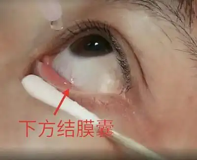 首页 医疗资讯 除医生特别交代外,眼膏一般宜晚上睡前使用,如果医嘱是