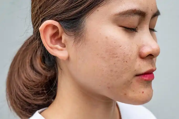 侧面特写的亚洲妇女的脸有各种各样的问题在她的皮肤上(如痤疮,丘疹