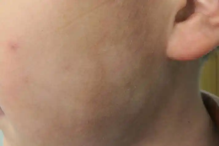 白色糠疹可导致患者皮肤表面出现白斑,多为淡白色,边缘不规则,与周围