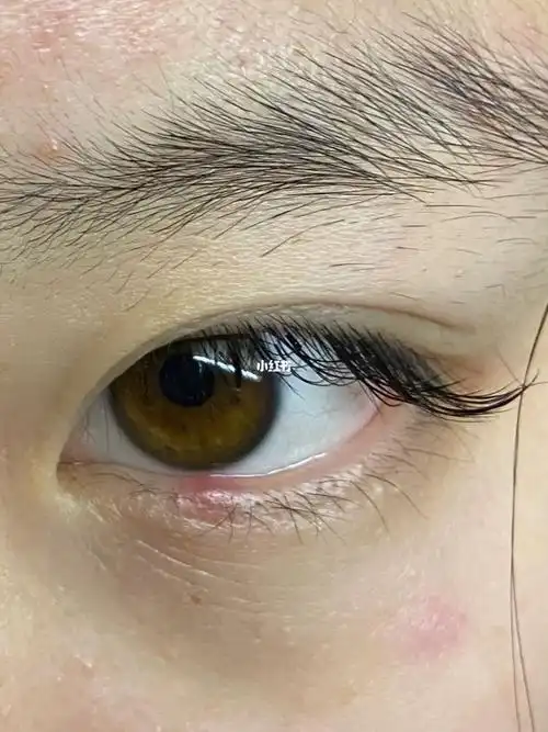 红霉素眼膏没用还能涂啥