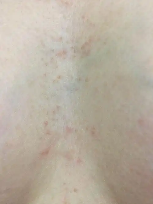 天一热就出来了,很多小红点,就胸口正中间竖着一条,肩颈大椎一