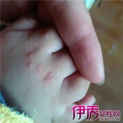 【图】小孩手湿疹图片大全 其症状及注意事项大盘点