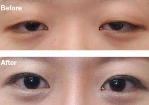 割双眼皮说是肌无力,双眼皮提肌有必要吗?什么叫提肌无力呢?