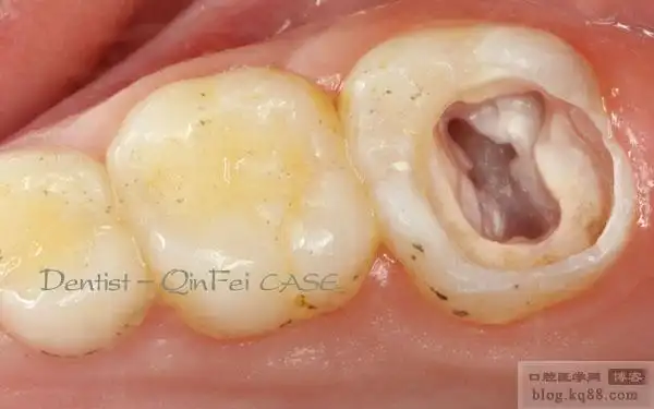 从口内到修复,寻找与平衡 安徽小牙(秦菲)_kq88口腔内科网