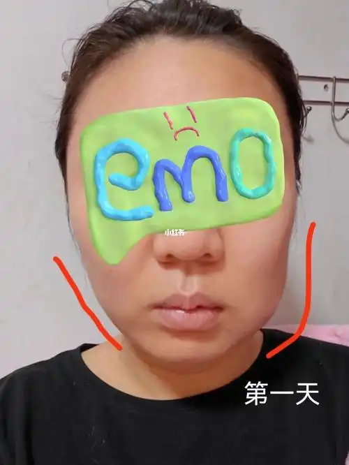 拔阻生智齿后脸越肿越大半夜低烧怀疑人生了