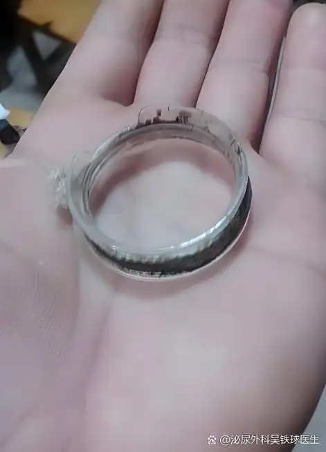 包茎包皮环切术后,环的脱落位置因人而异