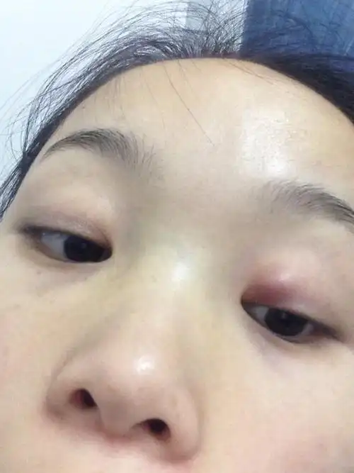 各种宝妈帮忙看看我这眼睛长个小包, 按时有点痛,这是什么.