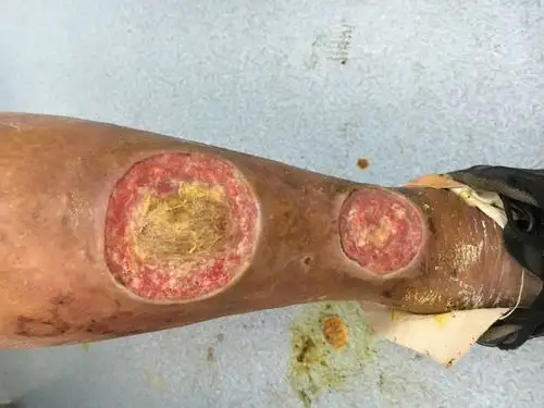 糖尿病皮肤溃疡并感染