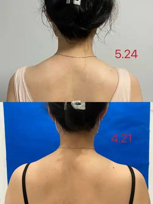 有这么神奇,如果是追求直角肩效果的可以放弃了#瘦肩针  #消除斜方肌