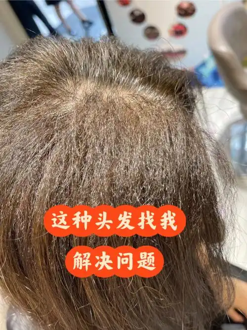 不同因素受损发质分析与解决头发烫焦