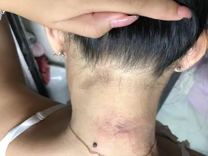 请医生看一下我脖子后长的一圈水泡是什么,有点痒痛,很久不见好.