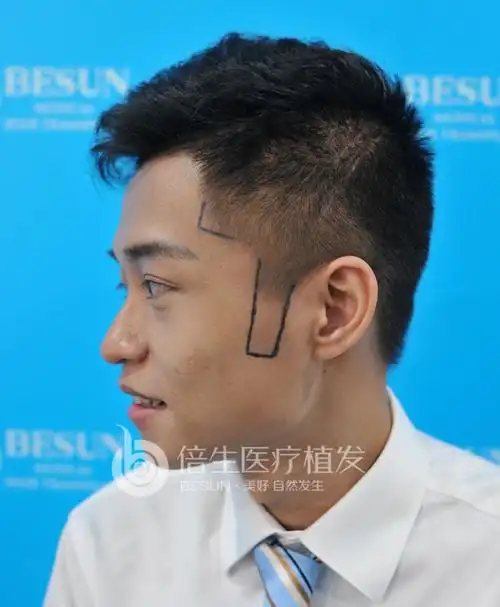 完美主义者刘桂彬霸气鬓角种植_经典案例_广州倍生植发医院_中华康网
