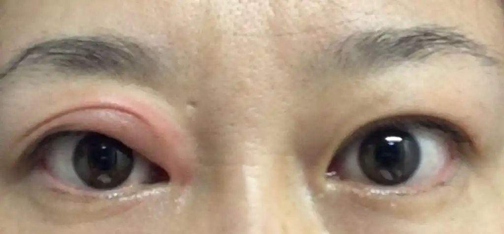 眼皮偶尔莫明水肿,有时下眼皮,有时上眼皮.