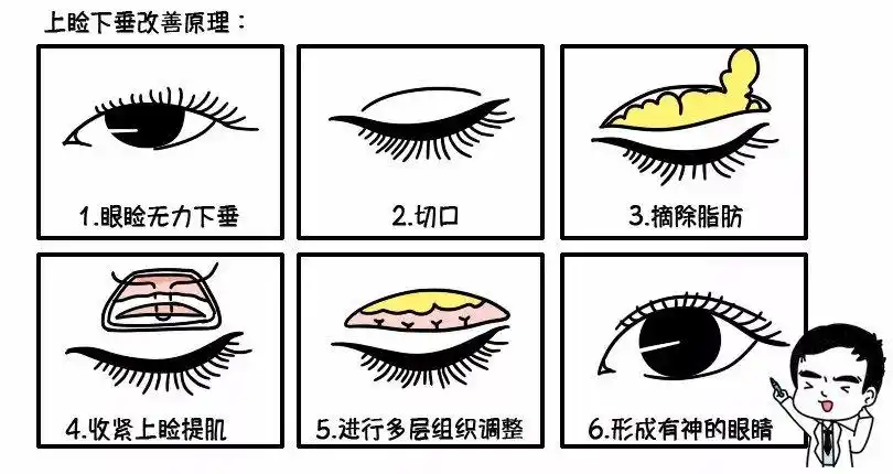 为什么那多人选择做双眼皮手术?