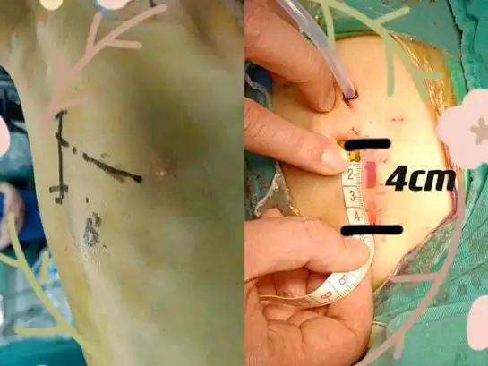 心脏手术之腋下小切口