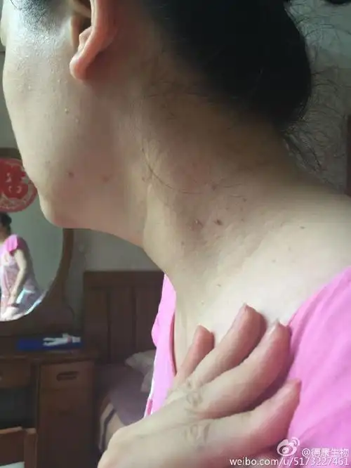 #脖子上丝状疣根治方法# #浓缩型东方妙水#... 来自德康生物 - 微博