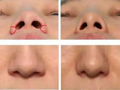 鼻翼宽整形