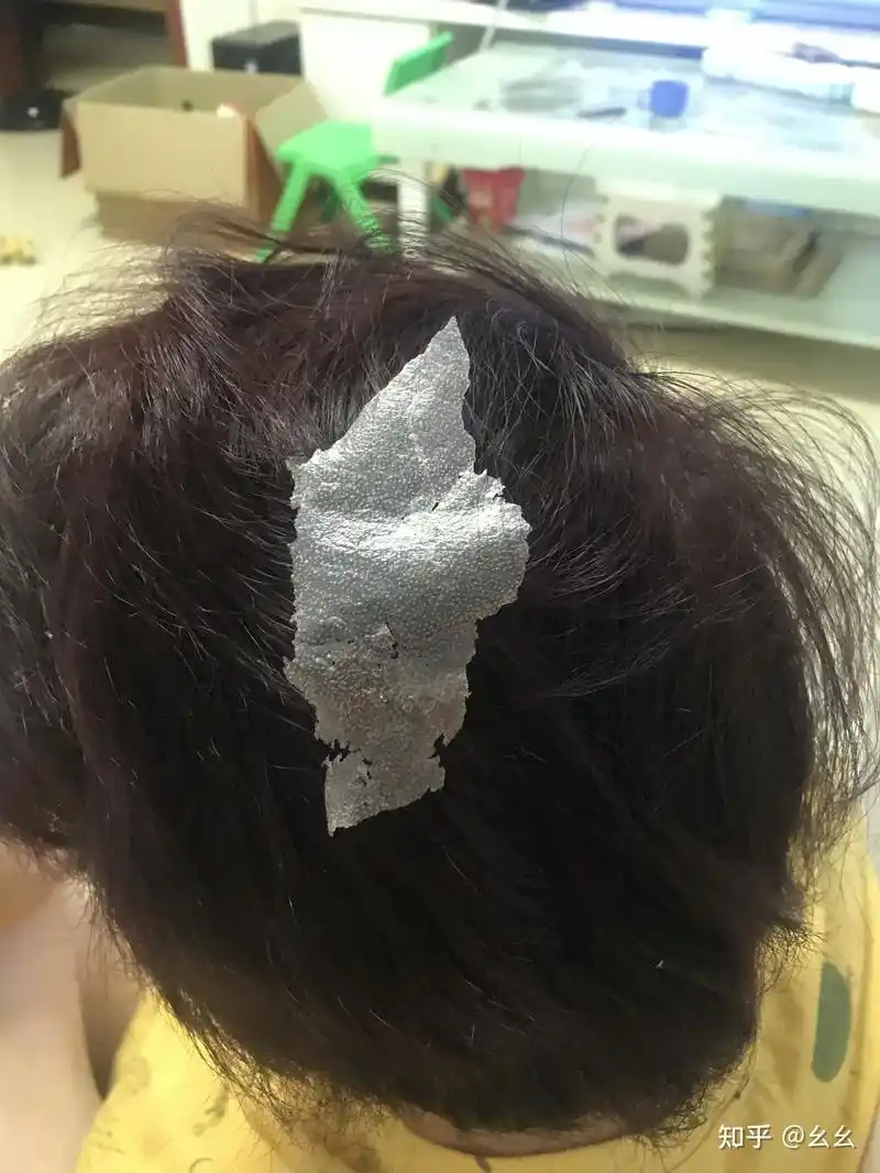 见过的最大头皮屑多大