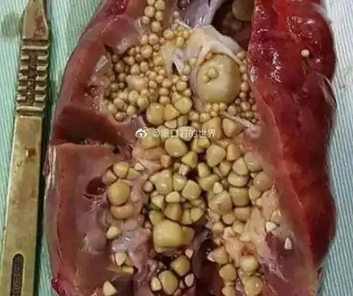 左右滑动查看更多(恐血者止步)>>>脏器结石形成的人体珍珠过于血腥