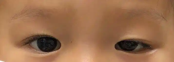 孩子上眼睑下垂什么时候手术合适