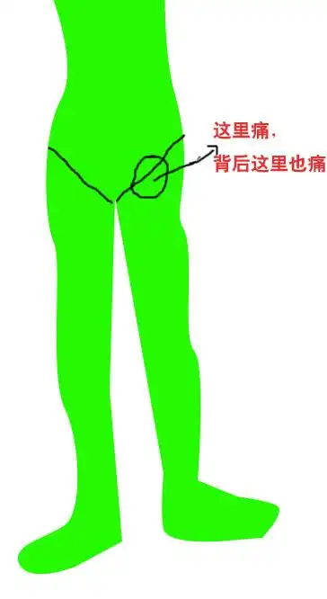 大腿根部痛