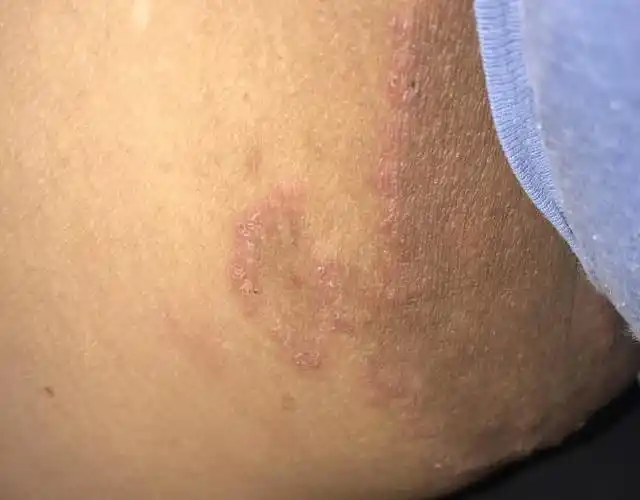 大腿根皮肤又红又痒确诊是真菌感染的股癣用药后却严重了