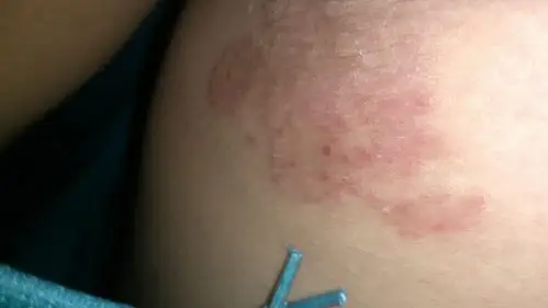 两条大腿内侧接近阴部地方有红斑,非常瘙痒,忍不住用力抓挠,抓挠用力