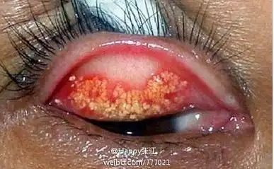 恐怖   近日网友"@勤勤小丸子"发微博爆料":最近一直觉得眼睛里有东西