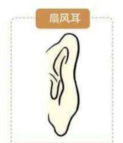 其实也就是招风耳,招风耳耳大招风,耳朵大且向外翻出向前生长.