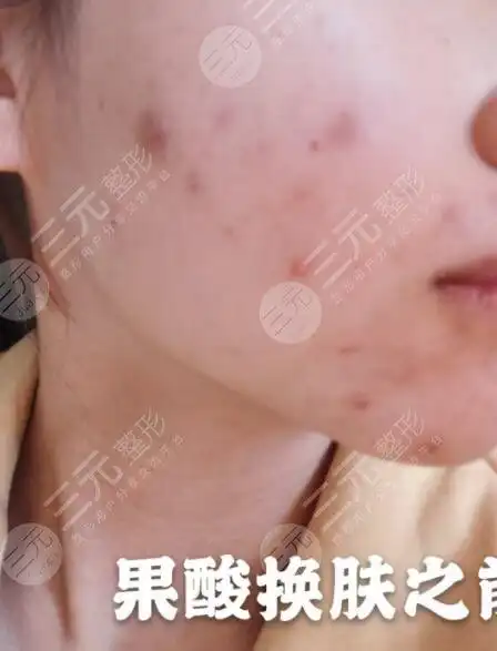 果酸换肤7大禁忌人群|果酸换肤效果展示