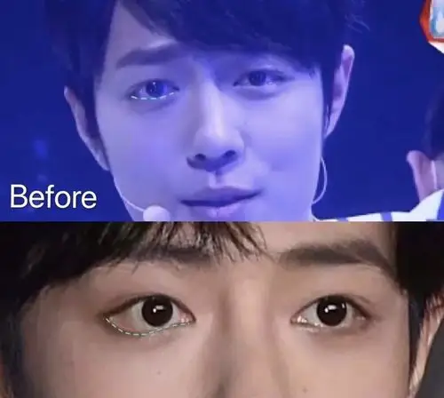 眼皮线条变得明显,也有可能让眼睛变大,露瞳度变高,但是不会让下眼睑