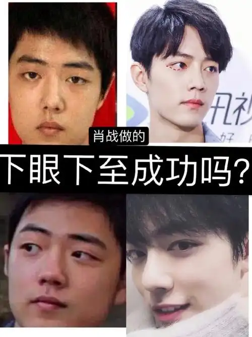 7915肖战有没有做下眼下至术,我觉得是有的.