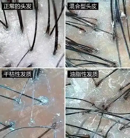 头发油腻不健康?教你如何判断自己的发质 - 金毛囊植发