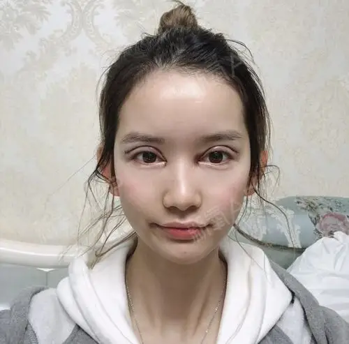 趁过年前去做了一个眼部多项,做的是欧式双眼皮,不知道_圈子-新氧美容