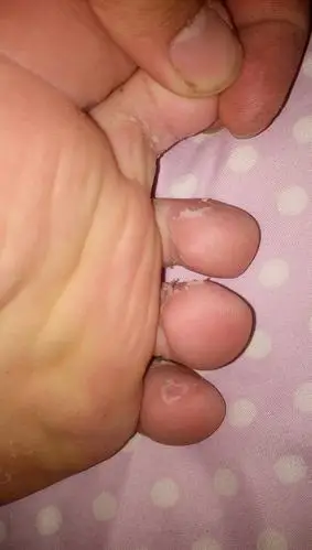 我脚爱出汗,我整天又穿着运动鞋上班,现在脚就成这