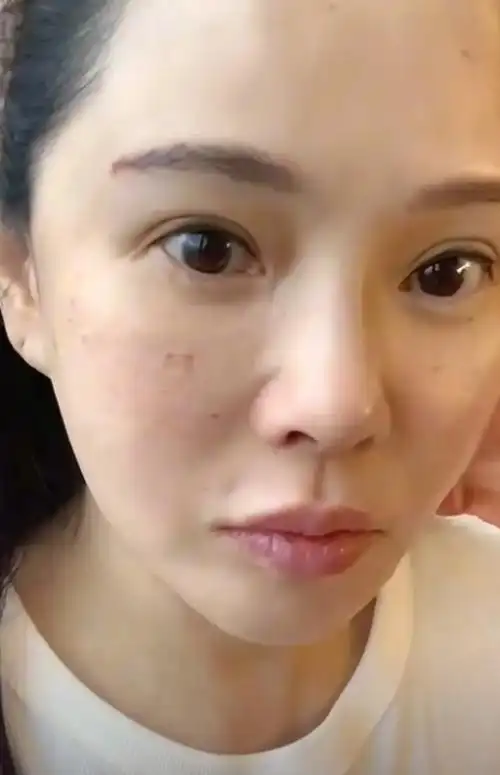 原创秦昊老婆跑韩国打水光针56岁伊能静满脸针眼直言痛得值得