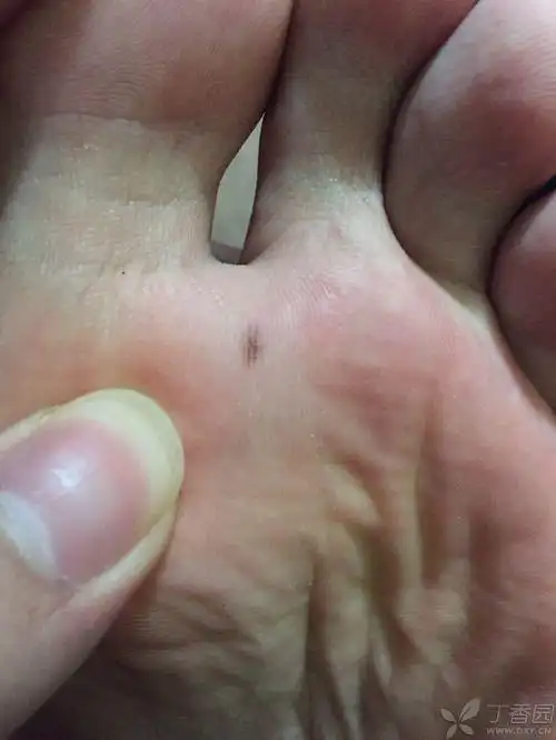 脚底长了一颗痣 [病例帖]