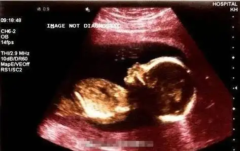 nt检查胎儿的配合少不了这个时间段nt的厚度可测量到的几率在90以上