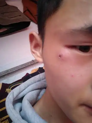 眼睛下面长了一个红包,慢慢的就变成脓包了,眼睛还