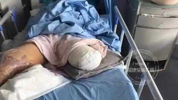 福州一90后女孩两条腿被撞断其中一条还被截肢肇事货车却跑了