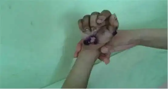 1993年燕志云虐女案:滚油灌嘴纱线封口,出狱掘坟踩女儿骨灰泄愤