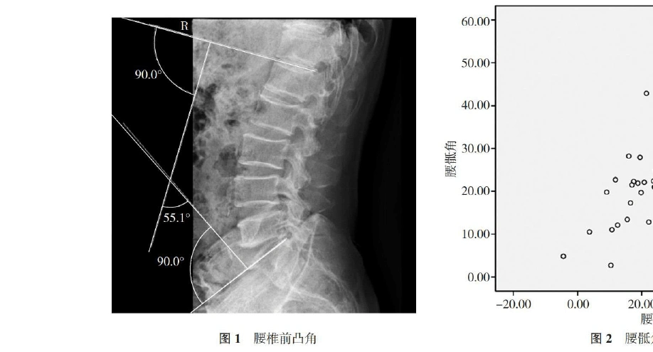 腰骶角和腰椎曲度的相关性研究