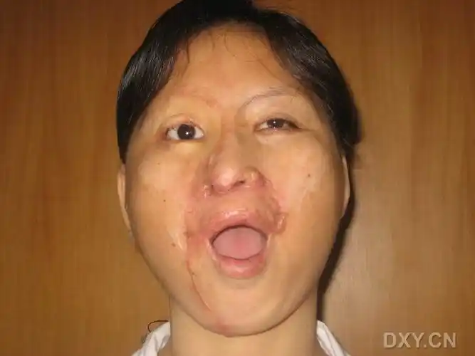 讨论〕面部烧伤患者的鼻畸形,修复方法?