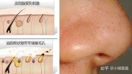 而这令人厌恶的黑头,其实是由皮肤油脂分泌过多构成毛孔阻塞构成的