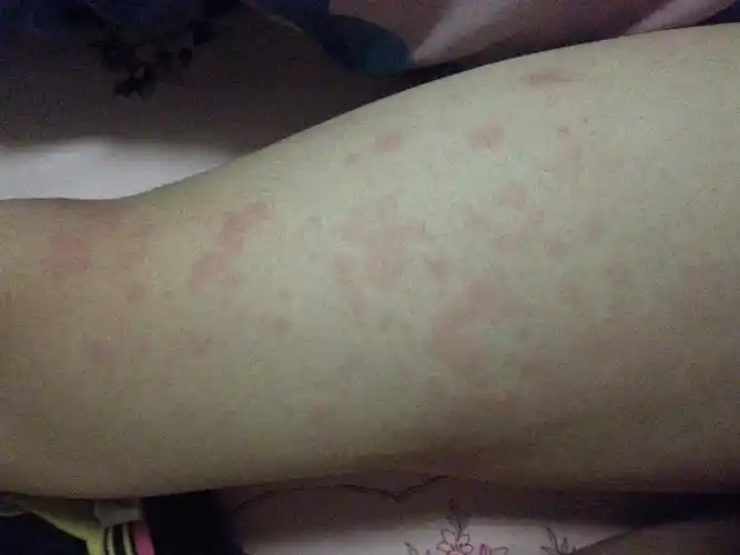 大腿痒,一挠起一片包,是什么?有图 不知是风疹还是荨麻疹,是否传染?