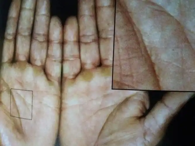 风水玄学  手相掌纹 肝区掌色的改变与肿瘤有什么特殊关系肝区掌色的