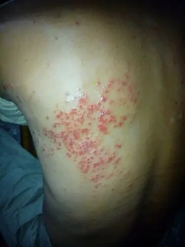 我爸爸背上长了这个,他不去医院看,我们也不知道是什么,请问这是什么